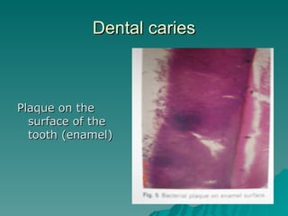 Dental caries Plaque on the surface of the tooth (enamel) 