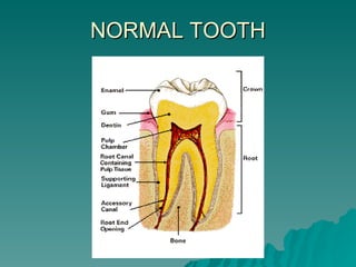 NORMAL TOOTH 