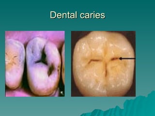 Dental caries 