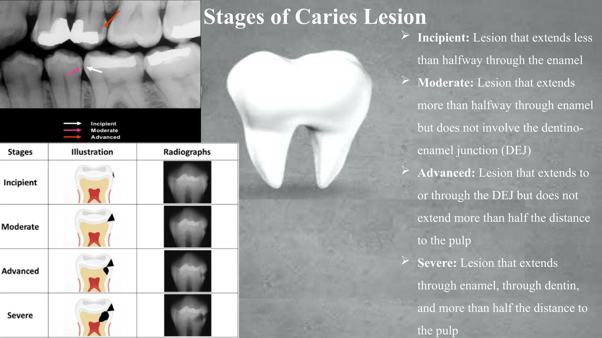powerpoint presentation about dental caries | PPTX