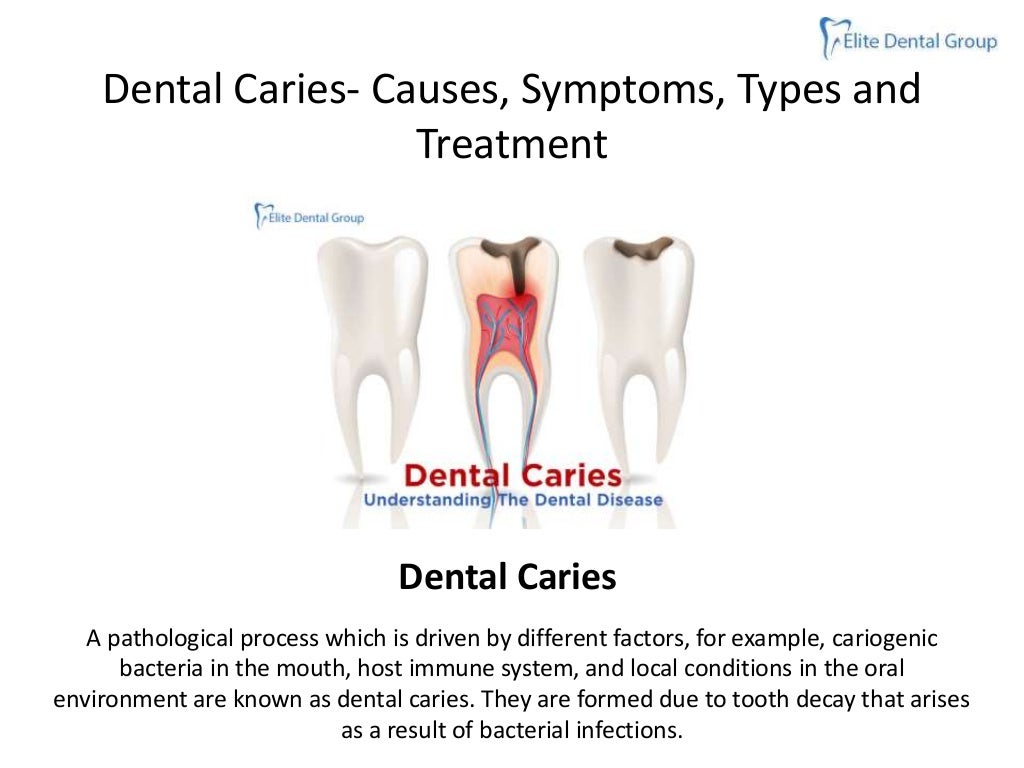 Dental cariescausessymptomstypestreatment