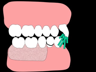 Dental Implant Presentation