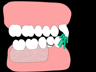 Dental Implant Presentation