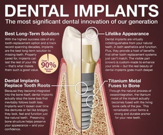 Dental Implants [infographic]
