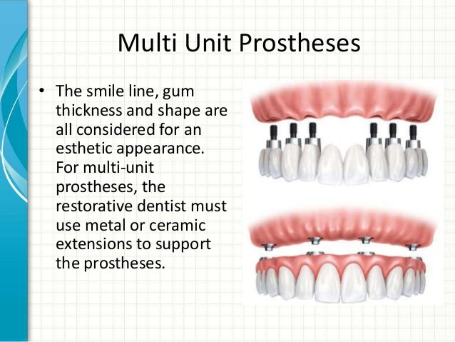 how-to-select-a-dental-implant-specialist-by-piney-point-oms-22-638.jpg?cb=1375781848