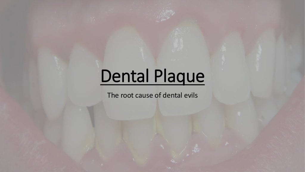 Dental Plaque Explained