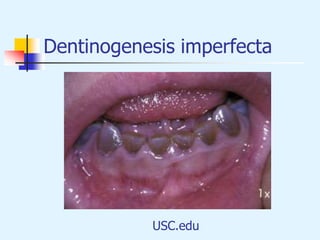 Dentinogenesis imperfecta
USC.edu
 