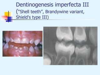 Dentinogenesis imperfecta III
(“Shell teeth”, Brandywine variant,
Shield's type III)
 