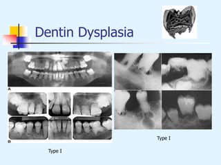 Dentin Dysplasia
Type I
Type I
 