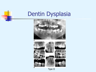 Dentin Dysplasia
Type II
 