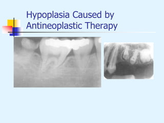 Hypoplasia Caused by
Antineoplastic Therapy
 