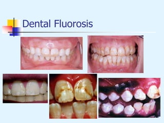 Dental Fluorosis
 