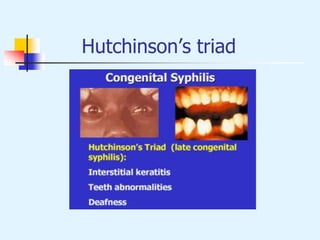 Hutchinson’s triad
 