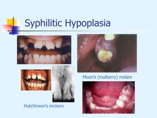 Syphilitic Hypoplasia
Hutchinson’s incisors
Moon’s (mulberry) molars
 