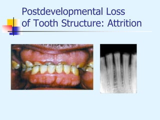 Postdevelopmental Loss
of Tooth Structure: Attrition
 