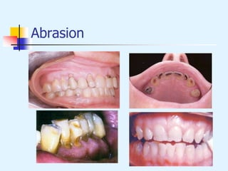 Abrasion
 