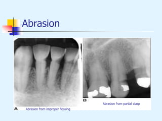 Abrasion
Abrasion from improper flossing
Abrasion from partial clasp
 