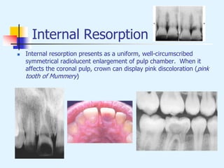 Internal Resorption
 Internal resorption presents as a uniform, well-circumscribed
symmetrical radiolucent enlargement of pulp chamber. When it
affects the coronal pulp, crown can display pink discoloration (pink
tooth of Mummery)
 