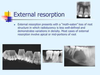 External resorption
 External resorption presents with a “moth-eaten” loss of root
structure in which radiolucency is less well-defined and
demonstrates variations in density. Most cases of external
resorption involve apical or mid-portions of root
 