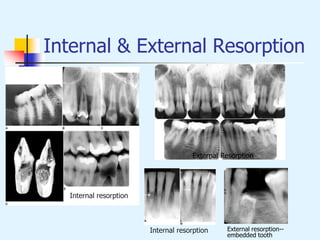 Internal & External Resorption
External Resorption
Internal resorption
Internal resorption
→
→
External resorption--
embedded tooth
 