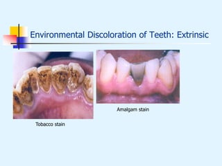 Environmental Discoloration of Teeth: Extrinsic
Tobacco stain
Amalgam stain
 