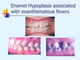 Enamel Hypoplasia associated
with exanthematous fevers
 