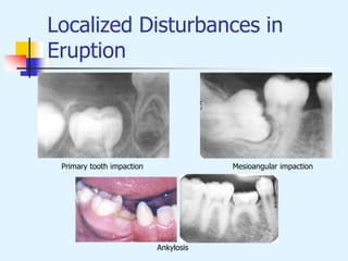 Localized Disturbances in
Eruption
Primary tooth impaction Mesioangular impaction
Ankylosis
 