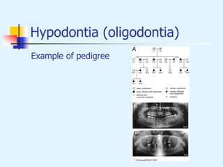 Hypodontia (oligodontia)
Example of pedigree
 