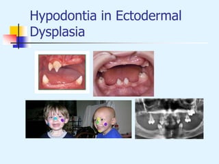 Hypodontia in Ectodermal
Dysplasia
 