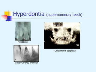 Hyperdontia (supernumeray teeth)
Mesiodens
Cleidocranial dysplasia
Supernumeray premolar
 