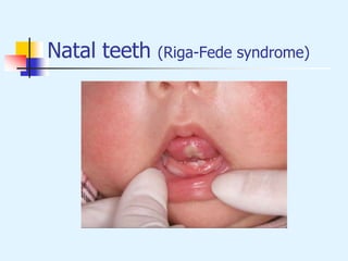 Natal teeth (Riga-Fede syndrome)
 