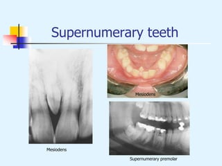 Supernumerary teeth
Mesiodens
Supernumerary premolar
Mesiodens
 