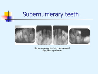 Supernumerary teeth
Supernumerary teeth in cleidocranial
dysplasia syndrome
 