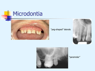 Microdontia
“peg-shaped” laterals
“paramolar”
 