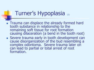 Turner’s Hypoplasia (2)
 Trauma can displace the already formed hard
tooth substance in relationship to the
remaining soft tissue for root formation
causing dilaceration (a bend in the tooth root)
 Severe trauma early in tooth development can
cause disorganization of the bud resembling a
complex odontoma. Severe trauma later on
can lead to partial or total arrest of root
formation.
 