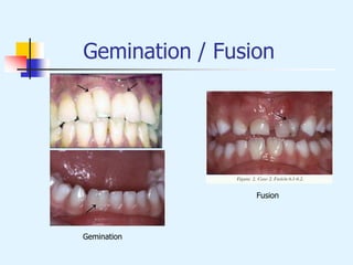 Gemination / Fusion
→
Gemination
Fusion
 