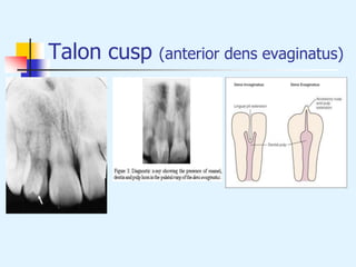Talon cusp (anterior dens evaginatus)
 