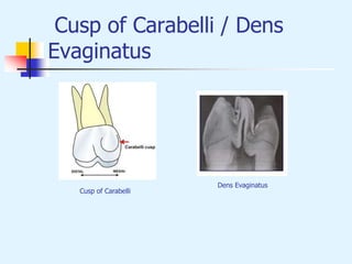 Cusp of Carabelli / Dens
Evaginatus
Dens Evaginatus
Cusp of Carabelli
 