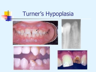 Turner’s Hypoplasia
 