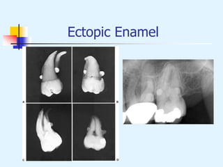 Ectopic Enamel
 