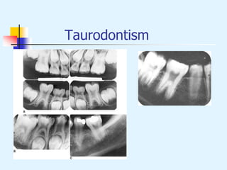 Taurodontism
 