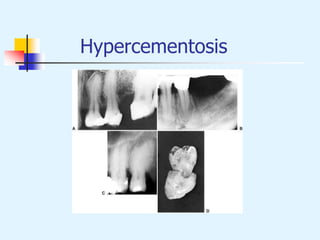 Hypercementosis
 