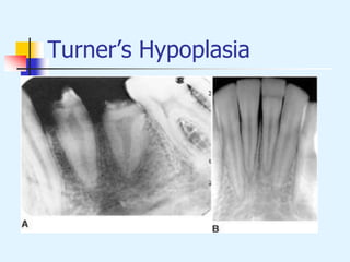 Turner’s Hypoplasia
 