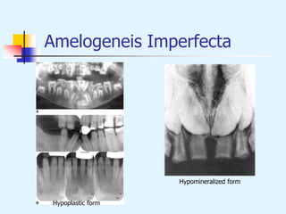 Amelogeneis Imperfecta
Hypoplastic form
Hypomineralized form
 