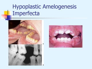 Hypoplastic Amelogenesis
Imperfecta
 