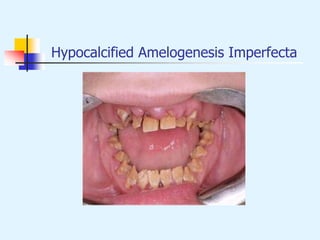 Hypocalcified Amelogenesis Imperfecta
 