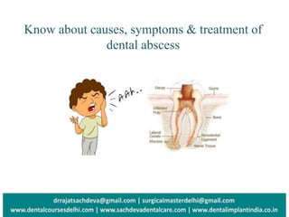 Know about causes, symptoms & treatment of
dental abscess
 