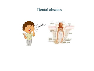 Dental abscess
 