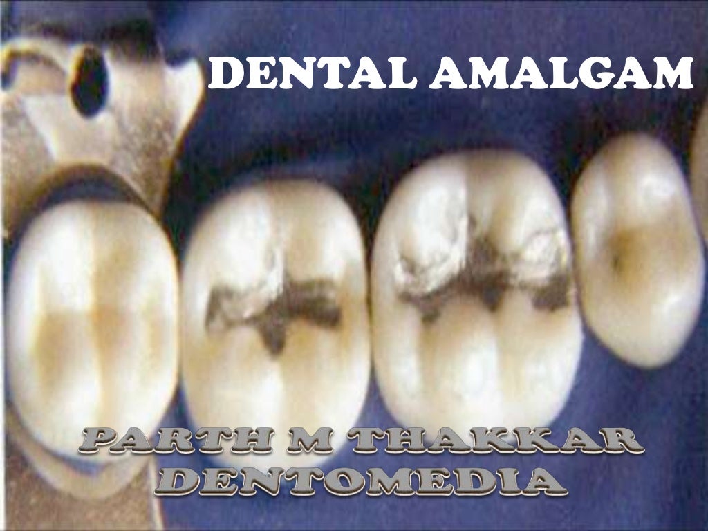 Dental amalgam
