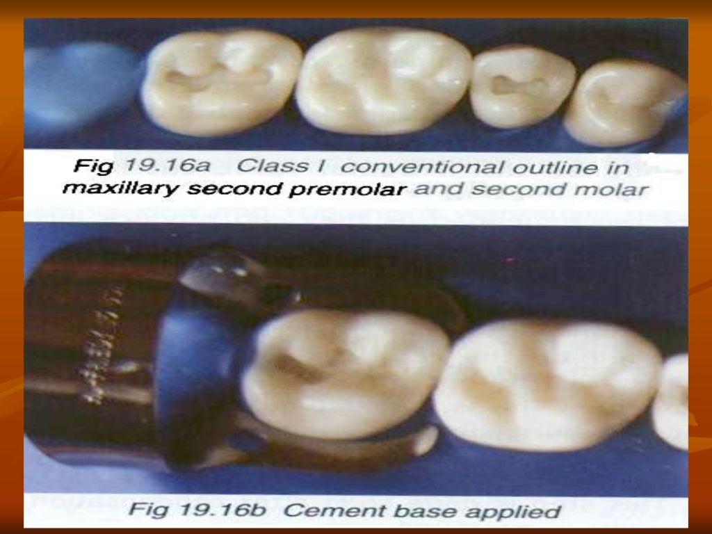 Dental amalgam